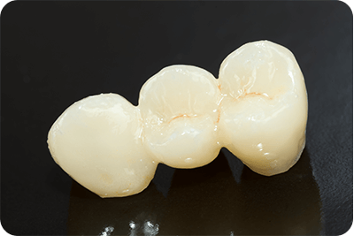 王子神谷・東十条・さわべ歯科クリニック王子神谷・ブリッジ