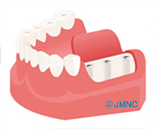 王子神谷・東十条・さわべ歯科クリニック王子神谷・インプラント体の埋入