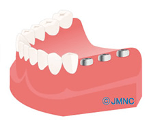 王子神谷・東十条・さわべ歯科クリニック王子神谷・アバットメントの装着