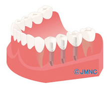 王子神谷・東十条・さわべ歯科クリニック王子神谷・人工歯の装着