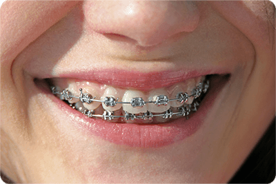 王子神谷・東十条・さわべ歯科クリニック王子神谷・ワイヤー矯正