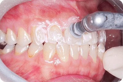 王子神谷・東十条・さわべ歯科クリニック王子神谷・PMTC